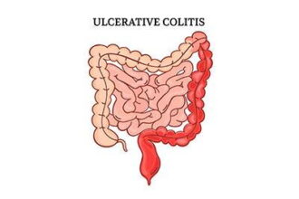 Colitis: Causes, Symptoms, and Treatments Explained